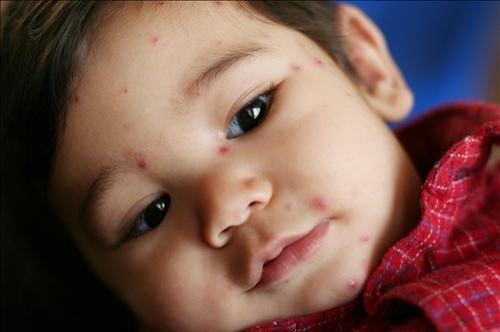 les boutons de varicelle chez l'enfant